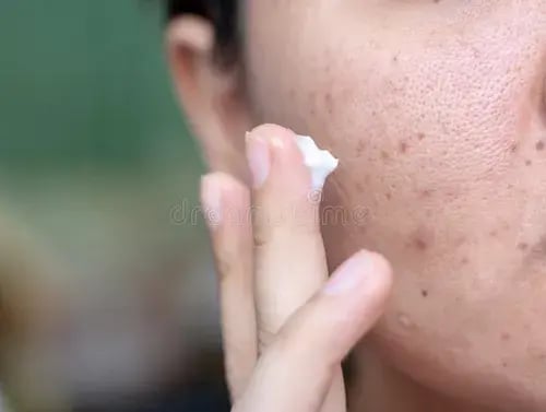 woman-applying-cream-onto-face-has-problem-problematic-skin-acne-scars-oily-pore-dark-spots-blackhead-whitehead-138214010